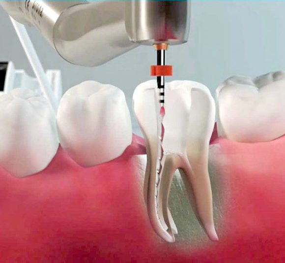 Endodonzia